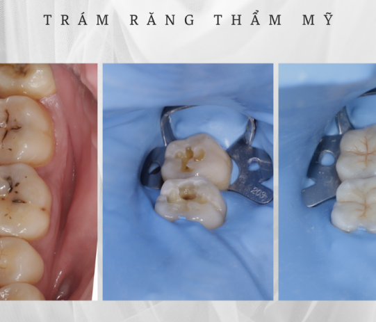 Trám răng thẩm mỹ